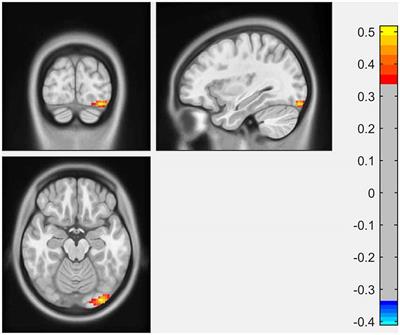 Altered Functional Network Associated With Cognitive Performance in Early Parkinson Disease Measured by Eigenvector Centrality Mapping